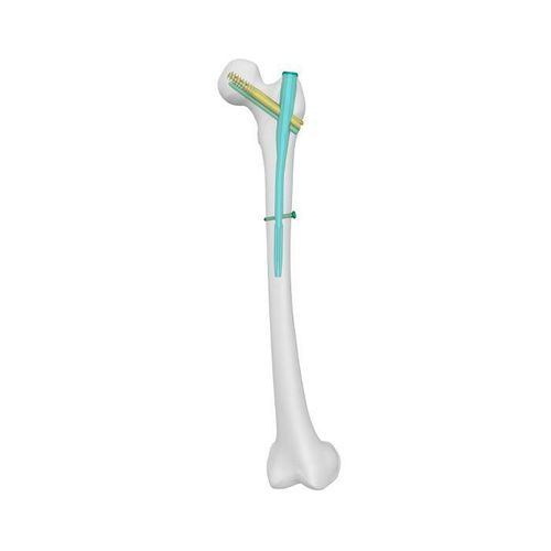 大腿骨用髄内釘 - PFCN - Double Medical Technology - 近位固定