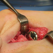 足の人工指節間関節 - HemiCAP DF®  - Arthrosurface
