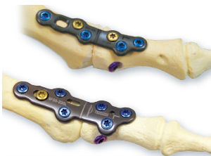 足指骨用関節固定プレート - CheckMATE® - Arthrosurface - ノンロッキング / 金属製