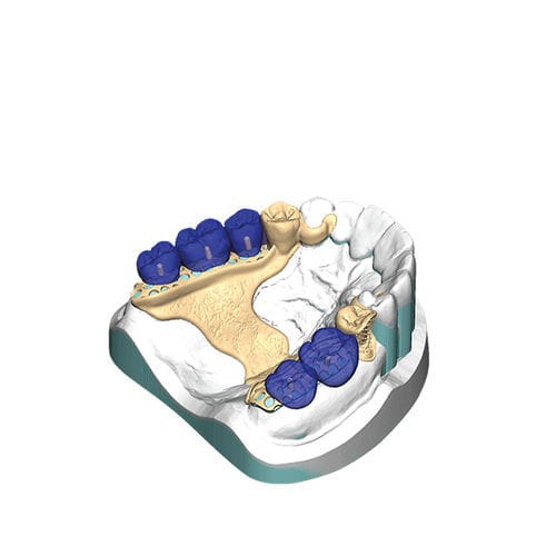 デザインソフトウェアモジュール - PartialCAD - exocad GmbH   - 印刷用 / 歯科技工所用 / 歯並び用