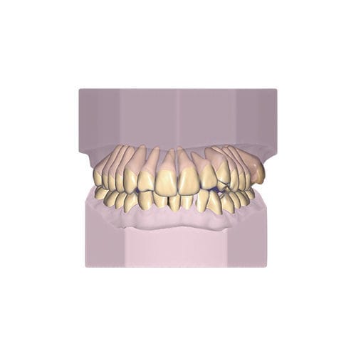 デザインソフトウェアモジュール - Ortho - exocad GmbH   - モデリング / 記録用 / 歯列矯正