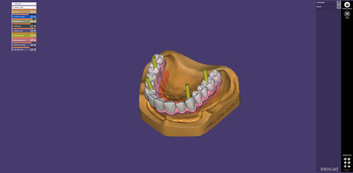 共有ウェブアプリケーション - webview - exocad GmbH   - 3D ヴィジュアリゼーション / 医療用 / 歯科用
