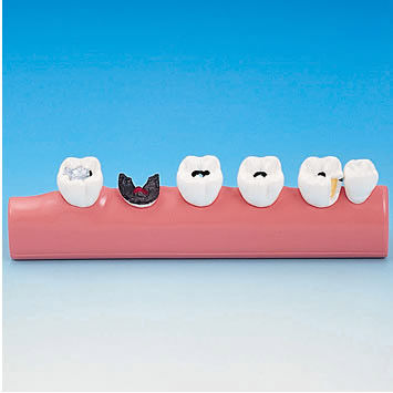 歯科用解剖模型 - PE-TDS005 - Nissin Dental Products Inc.   - 実習用 / 虫歯用