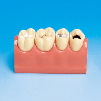 歯科用解剖模型 - PE-STP007 - Nissin Dental Products Inc.   - 実習用 / 虫歯用
