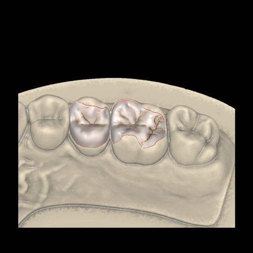 義歯デザイン用ソフトウェアモジュール - Inlays/Onlays/Veneers - Zirkonzahn - FAO / CAD / 歯科技工所用