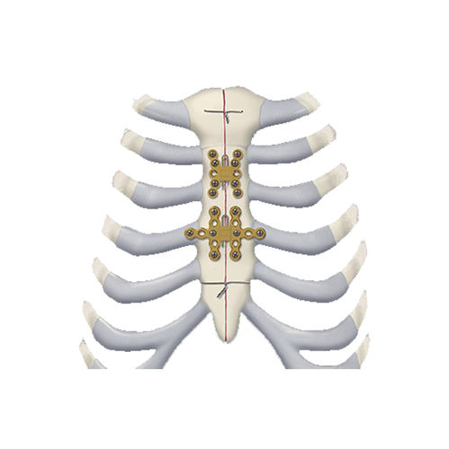 胸骨用関節固定プレート - 460 series - Depuy Synthes - 肋骨用 / ロッキング / チタン製