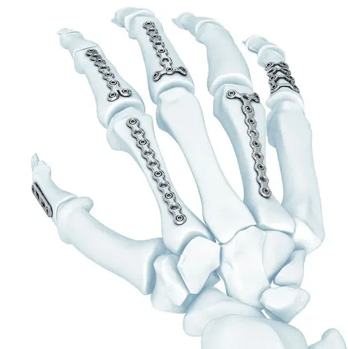 中手指節関節用圧迫プレート - LCP® - Depuy Synthes