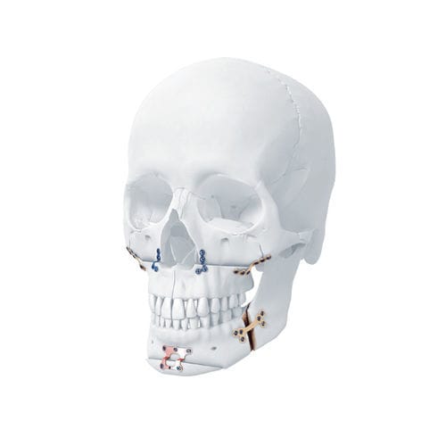 下顎骨用圧迫プレート - MatrixORTHOGNATHIC™ - Depuy Synthes