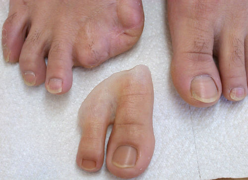 足指美容人口装具 - Aesthetic Prosthetics - 大人用