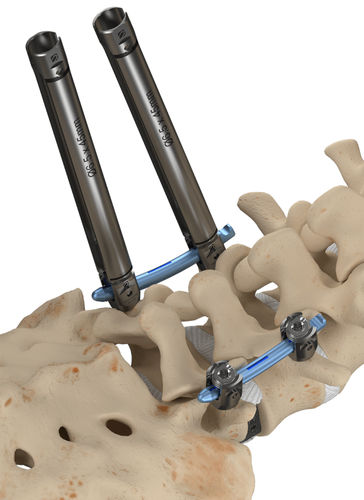 低侵襲椎弓根スクリュー位置決めシステム - Invictus™ - Alphatec Spine