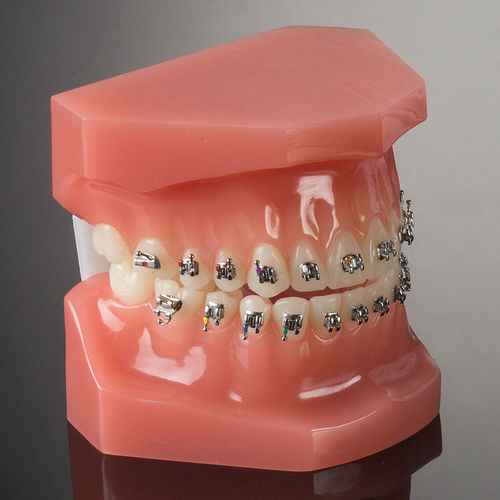 金属製矯正ブラケット - miniPrevail® - G&H Orthodontics - ツインフィン / 小型