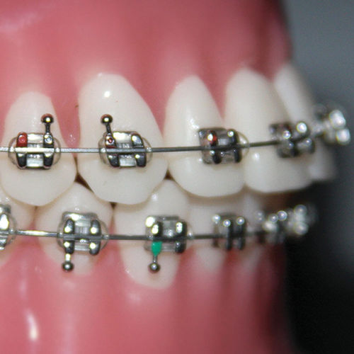 金属製矯正ブラケット - Focus™  - G&H Orthodontics - 小型