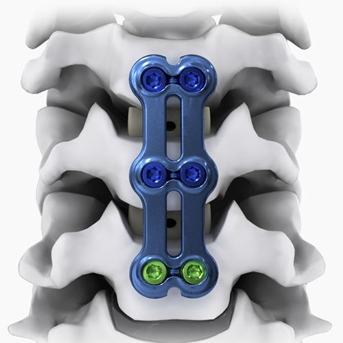 頸椎関節固定プレート - NEO®-SL - Life Spine - ロッキング / 金属製