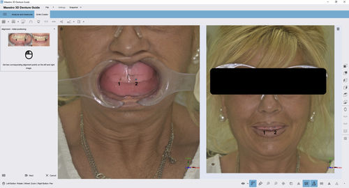 キャプチャーソフトウェアモジュール - 3D Denture Guide - AGE Solutions - 歯科用