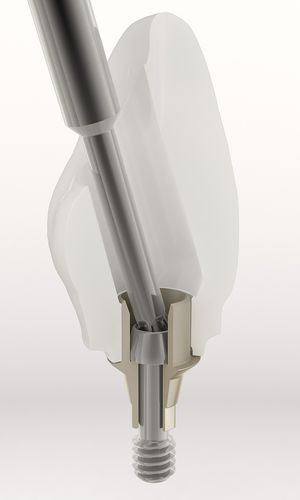 チタン製インプラントアバットメント - BH - DESS AURUM Base™ - Dess Dental Smart Solutions - エクスターナル六角形 / ストレートタイプ