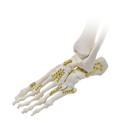 足用圧迫プレート - SIGNEX - OSTEONIC - ロッキング / 金属製