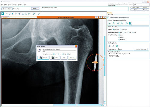 手術前プランニング用ソフト - Hip Arthroplasty - OrthoView - 腰手術 / 整形外科用 / 医療用