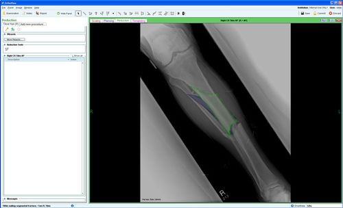 管理用ソフトウェアモジュール - Fracture Management - OrthoView - 計画用 / 整形外科用
