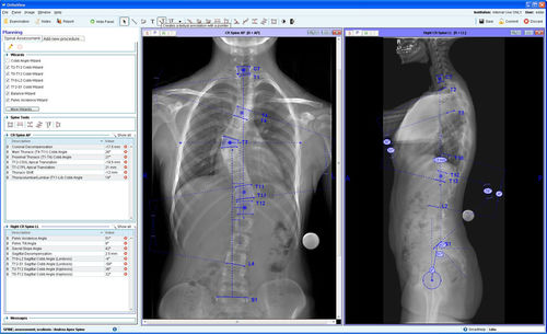 管理用ソフトウェアモジュール - Spinal Deformity Assessment - OrthoView - 手術前プランニング用 / 整形外科用 / 脊柱の
