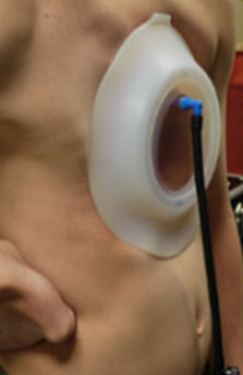 漏斗胸治療用バキュームベル - 03.000 series - Medicalex