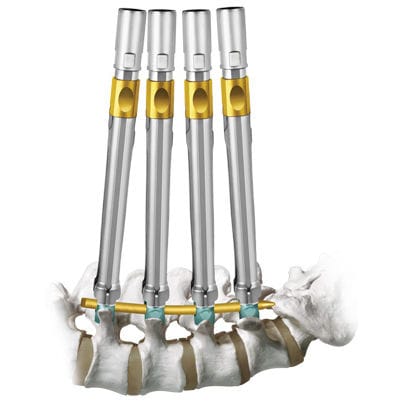 低侵襲椎弓根スクリュー位置決めシステム - REVOLVE® - Globus Medical
