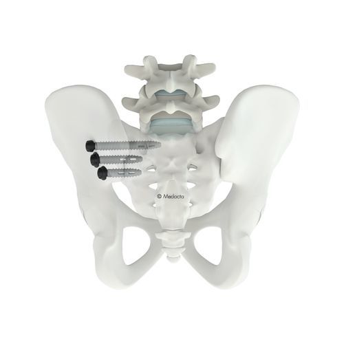 仙腸骨骨接合システム - M.U.S.T.® SI - Medacta - 後方進入