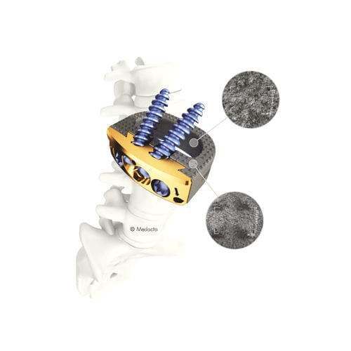 腰椎椎体間ケージ - MectaLIF® - Medacta - 前方進入 / 後方進入 / PEEK製