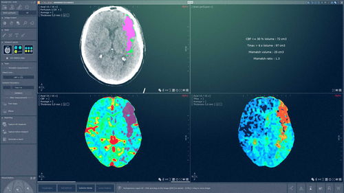 分析ソフトウェアモジュール - MYRIAN® XP-BRAIN - Intrasense - 管理用 / 可視化 / 診断用