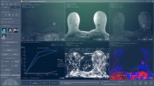 分析ソフトウェアモジュール - Myrian® XP-Breast - Intrasense - 可視化 / データ収集 / 航海用