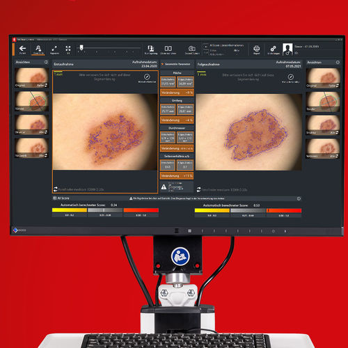 皮膚診断ソフト - Moleanalyzer pro - FotoFinder Systems - 研究用 / 皮膚科 / AIアシスト
