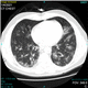 新型コロナウイルスの診断用ソフト / 医療用 / CT / イメージ分析