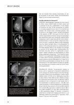Spiral Breast CT: Going Further with Photon Counting (Source: DIEurope)-3