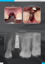 Bhi Implants Catalog-16