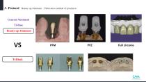 Beauty-up™ Abutment-14