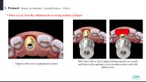 Beauty-up™ Abutment-16