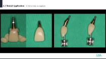Beauty-up™ Abutment-21