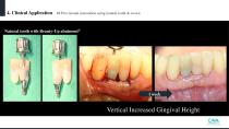 Beauty-up™ Abutment-25