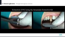 Beauty-up™ Abutment-26