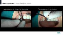 Beauty-up™ Abutment-28