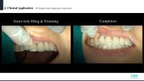 Beauty-up™ Abutment-30