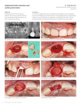 InterCollagen® Guide-4