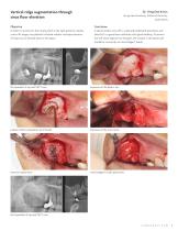 InterCollagen® Guide-5