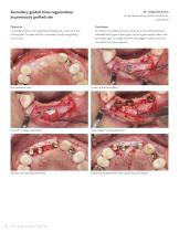 InterCollagen® Guide-6