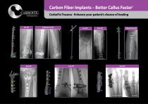 CarboFix "Piccolo" Distal Radius Plates - 4