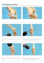 Isolock CrCL Procedure-3