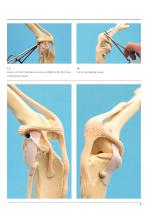 Isolock CrCL Procedure-5