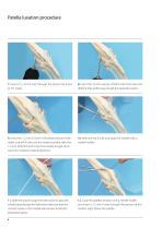 ISOLOCKPatellaProcedure-4