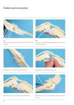 ISOLOCKPatellaProcedure-6