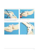 ISOLOCKPatellaProcedure-7