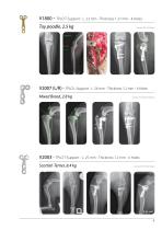 TPLO-3